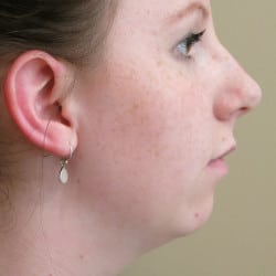 Chin Implant by Dr. Thompson