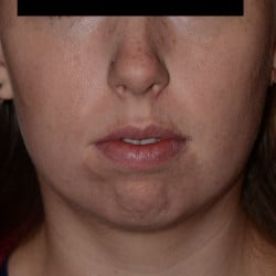 Chin Implant, Submental Liposuction by Dr. Thompson