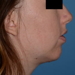 Chin Implant, Submental Liposuction by Dr. Thompson