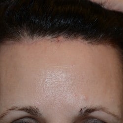 Forehead Reduction by  Dr. Thompson