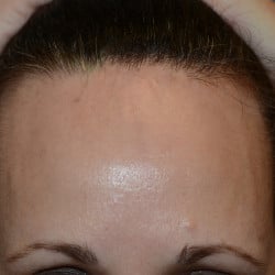 Forehead Reduction by  Dr. Thompson