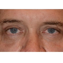 Upper Eyelid Surgery by Dr. Thompson