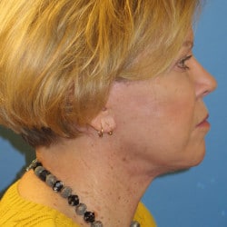 Facelift, Browlift, Upper and Lower Blepharoplasty by Dr. Thompson
