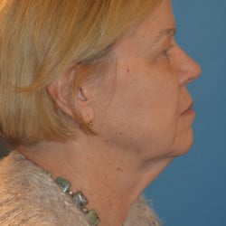 Facelift, Browlift, Upper and Lower Blepharoplasty by Dr. Thompson