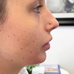 Chin Enhancement with Filler