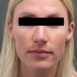 Revision Rhinoplasty by Dr. Thompson