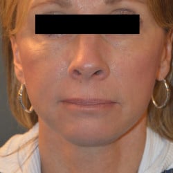 Facelift and Perioral Dermbrasion by Dr. Thompson