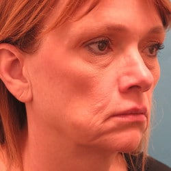 Macslift, Fat Injections, Lower Eyelids, and Septoplasty by Dr. Thompson