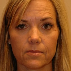 Liquid Facelift with Filler and Botox