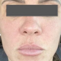 Filler for Facial Lines and Volume Loss