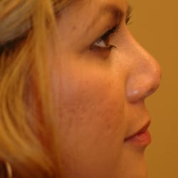 Implant Removal and Revision Rhinoplasty by Dr. Thompson