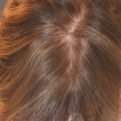 Hair Loss Treatment with Acell Hair Restoration