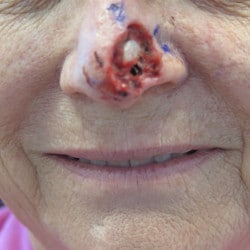 Moh’s Reconstruction by Dr. Henstrom