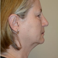 Facelift, Upper & Lower Blepharoplasty by Dr. Thompson