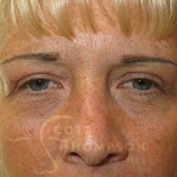 Upper Blepharoplasty | Eyelid Surgery | Utah Facial Plastics 358