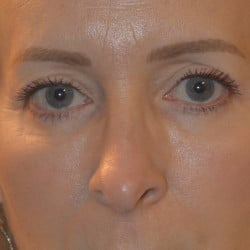 Upper Blepharoplasty, Lower Lid Skin Pinch, & Periorbital Fat Injections by Dr. Thompson