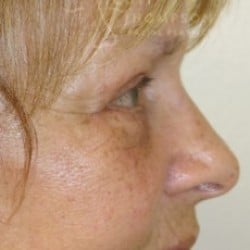 Upper & Lower Blepharoplasty (Eyelid Lift) 815