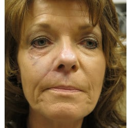 Liquid Facelift by Dr. Thompson