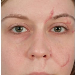 Scar Revision by Dr. Henstrom