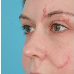 Scar Revision by Dr. Henstrom