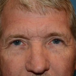 Direct Browlift and Upper Blepharoplasty  by Dr. Thompson