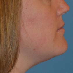 Submental Liposuction by Dr. Henstrom