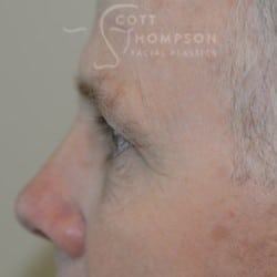 Upper Eyelid Surgery | Utah Facial Plastics – 432