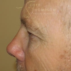 Upper Eyelid Surgery | Utah Facial Plastics – 432