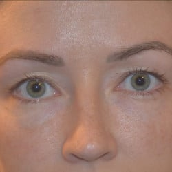Peri-orbital Fat Injections by Dr. Thompson