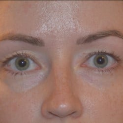 Peri-orbital Fat Injections by Dr. Thompson
