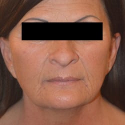 Facelift and Fat Grafting by Dr. Thompson