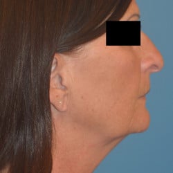 Facelift and Fat Grafting by Dr. Thompson