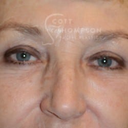 Upper Eyelid Surgery | Lower Eyelid Surgery with Fat Respositioning – 901