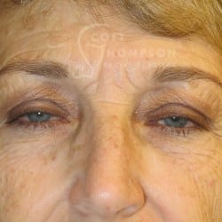 Upper Eyelid Surgery | Lower Eyelid Surgery with Fat Respositioning – 901