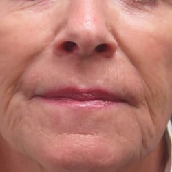 Lip Lift by Dr. Henstrom