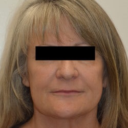 Macslift and Perioral Dermabrasion by Dr. Henstrom