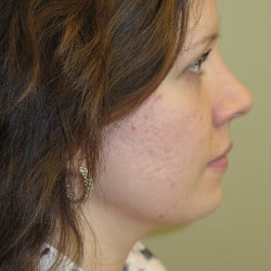 Macslift, Chin Implant, Nasal Narrowing by Dr. Thompson