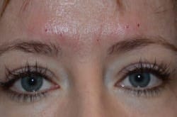 Upper Eyelid Surgery | Lower Eyelid Surgery with Fat Injections – 545