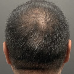 Hair Loss Treatment with Acell
