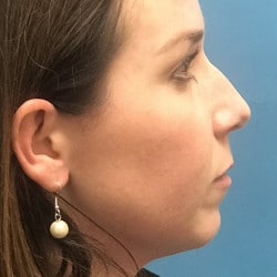 Rhinoplasty, Chin Implant, Lip Lift by Dr. Thompson