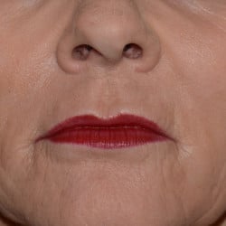 Lip Lift by Dr. Thompson