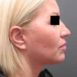 Facelift by Dr. Henstrom