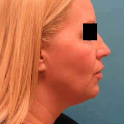 Facelift by Dr. Henstrom