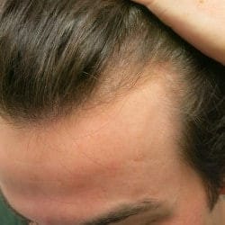 FUE Hair Transplant by Dr. Thompson