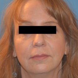 Facelift, Chin Implant, Periorbital Fat Transfer by Dr. Thompson
