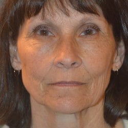 Facelift, Fat Transfer, and Lower Blepharoplasty by Dr. Thompson