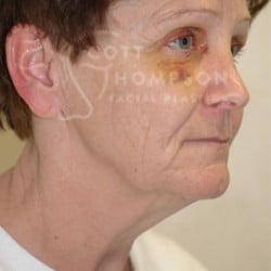 Facelift Before and After Photos | Utah Facial Plastics 281