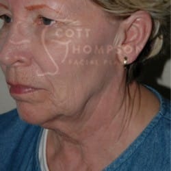 Facelift Before and After Photos | Utah Facial Plastics 285