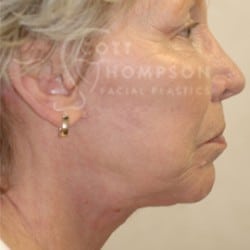 Facelift Before and After Photos | Utah Facial Plastics 285