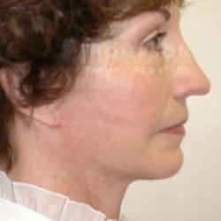 Facelift Before and After Photos | Utah Facial Plastics 286